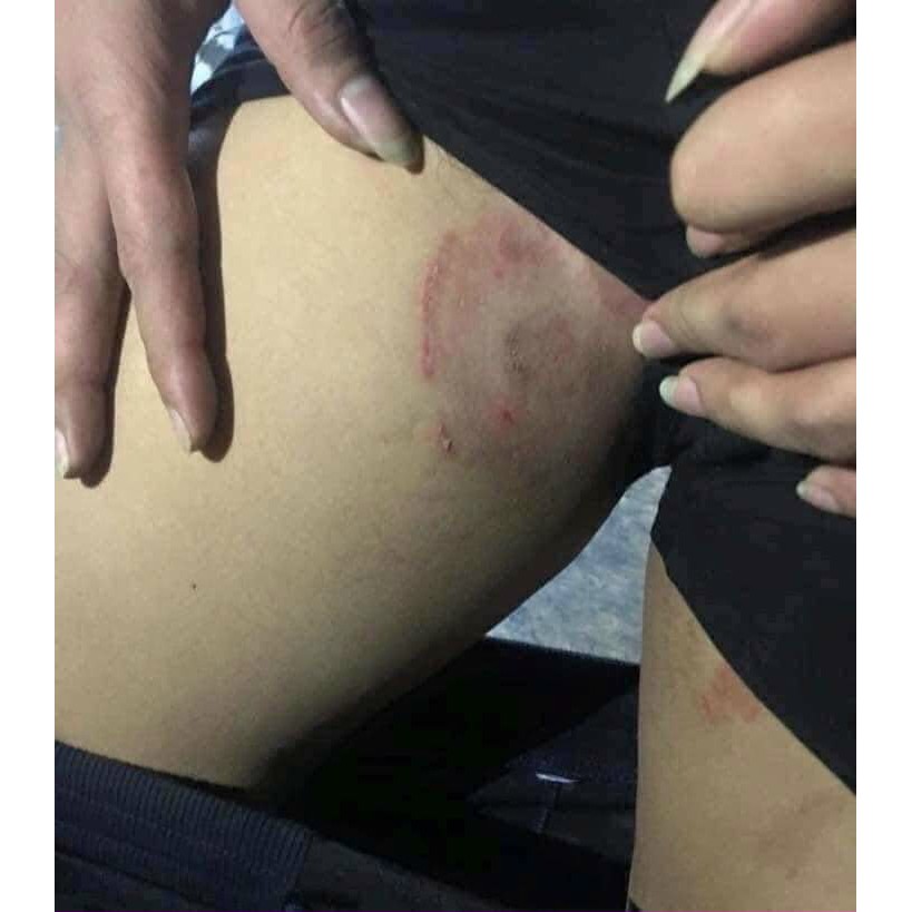 kem bôi nấm ngứa, vảy nến, á sừng, hắc lào - Hàng có sẵn | BigBuy360 - bigbuy360.vn