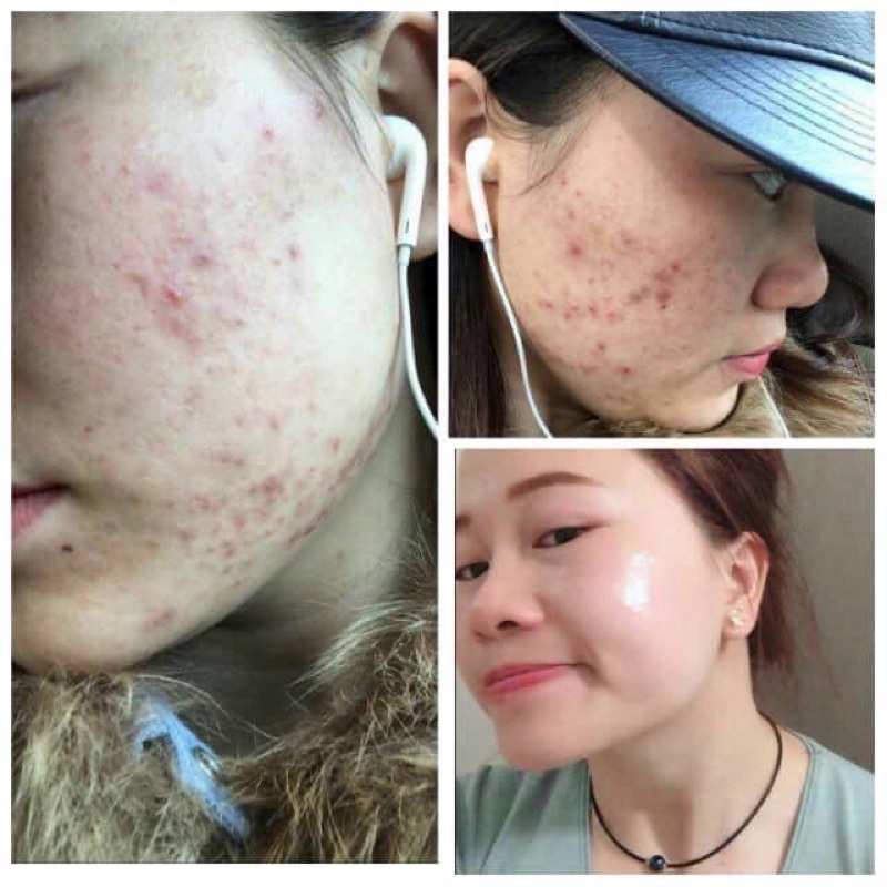 TRETINOIN_ARET_USP  Tretinoin 0.1%, 0.05%, 0.025%, GEL GIẢM MỤN, TRẺ HÓA DA