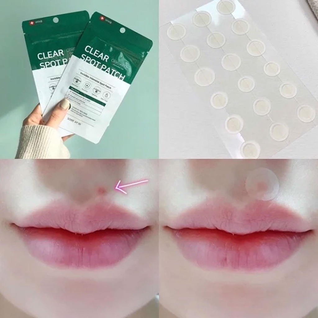 Miếng Dán Mụn Some By Mi Acnes Clear Patch