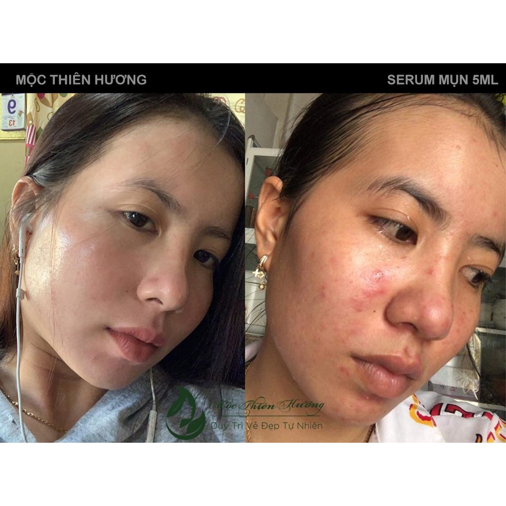 Serum giảm mụn thâm rỗ, sáng da, se khít lỗ chân lông Mộc Thiên Hương 50ml | BigBuy360 - bigbuy360.vn
