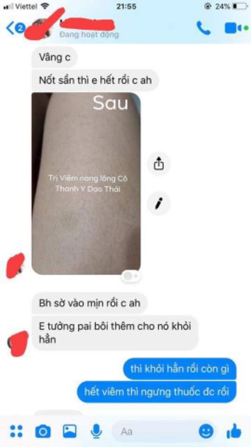 Viêm nang lông | BigBuy360 - bigbuy360.vn