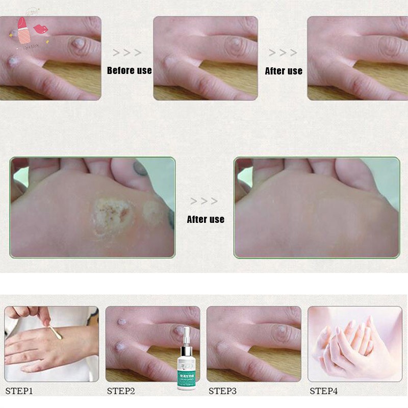 10ml Mole Skin Tag Repairing Solution Painless Tag Repair Freckle Repair Face Wart Mole Skin Cream