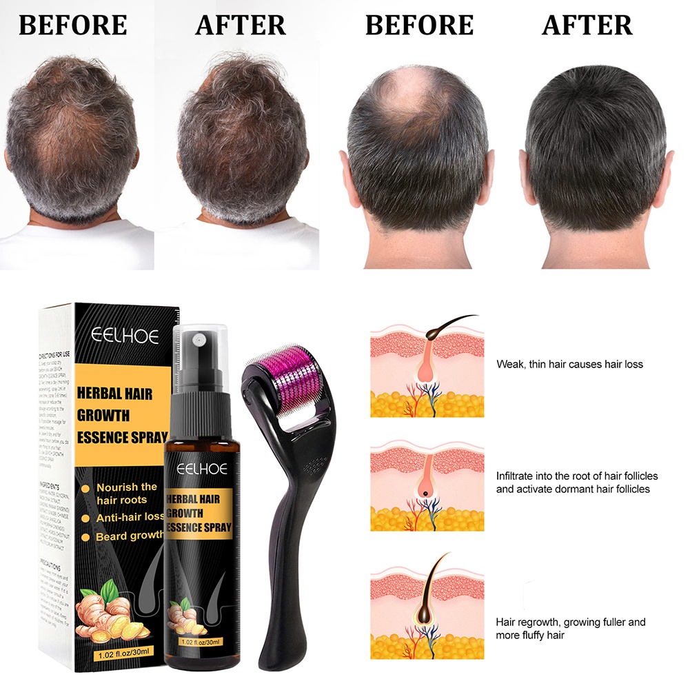 Set dung dịch kích thích mọc tóc và cây lăn kim nhỏ EELHOE hiệu quả tiện lợi