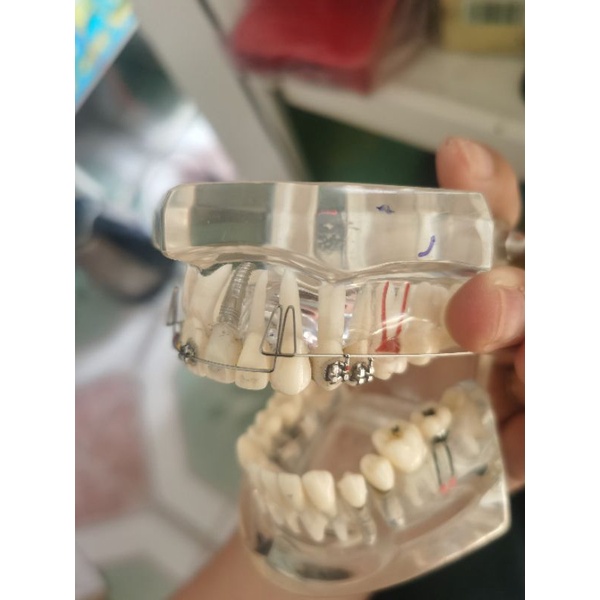 Loop Double Delta,  đóng khoảng kéo lui 4 răng cửa, chỉnh nha Bio