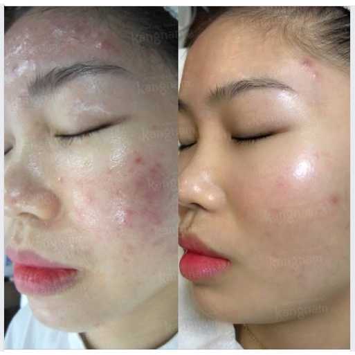 Kem dưỡng ngày đêm cho da dầu mụn, mờ thâm mụn Bielenda Dr. Medica Anti-acne Dermatological 50ml