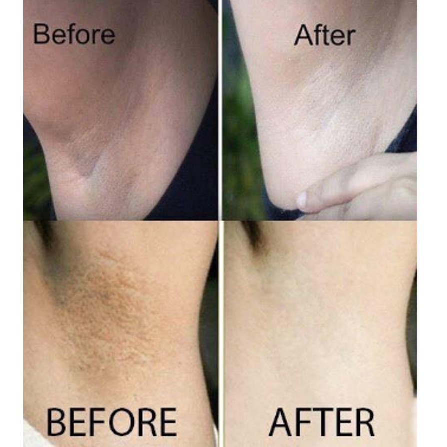 Kem Hỗ Trợ giảm Thâm đặc biệt vùng dưới cánh tay Q-nic Care Whitening Underarm Cream Thái Lan