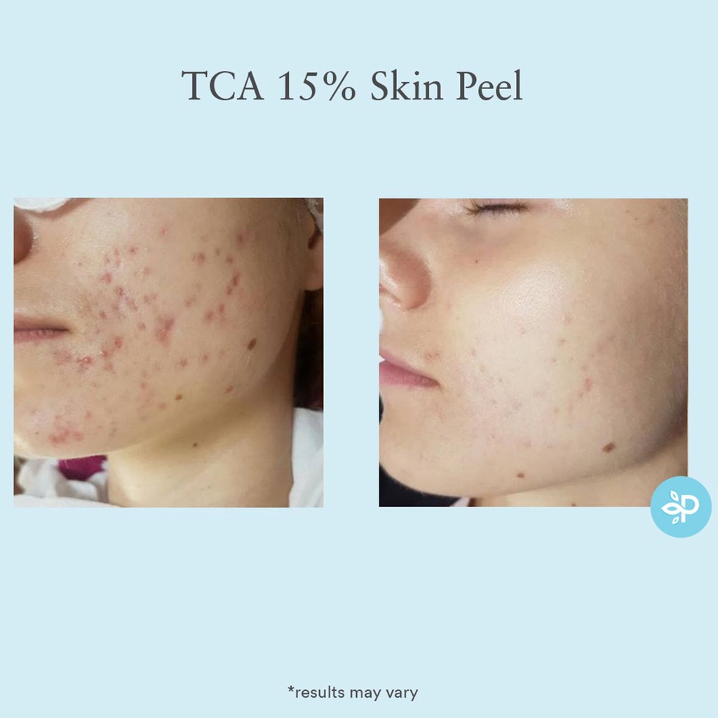 Thay da sinh học PEEL PERFECT IMAGE SALICYLIC ACID 20%, TCA 15%. GLYCOLIC ACID 50%, LACTIC ACID 50%