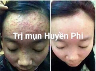 Mặt nạ mụn Huyền Phi(120k)