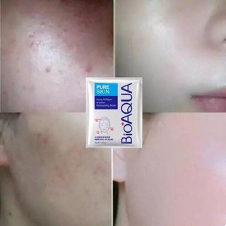Mặt nạ trị mụn Bioaqua Pure Skin