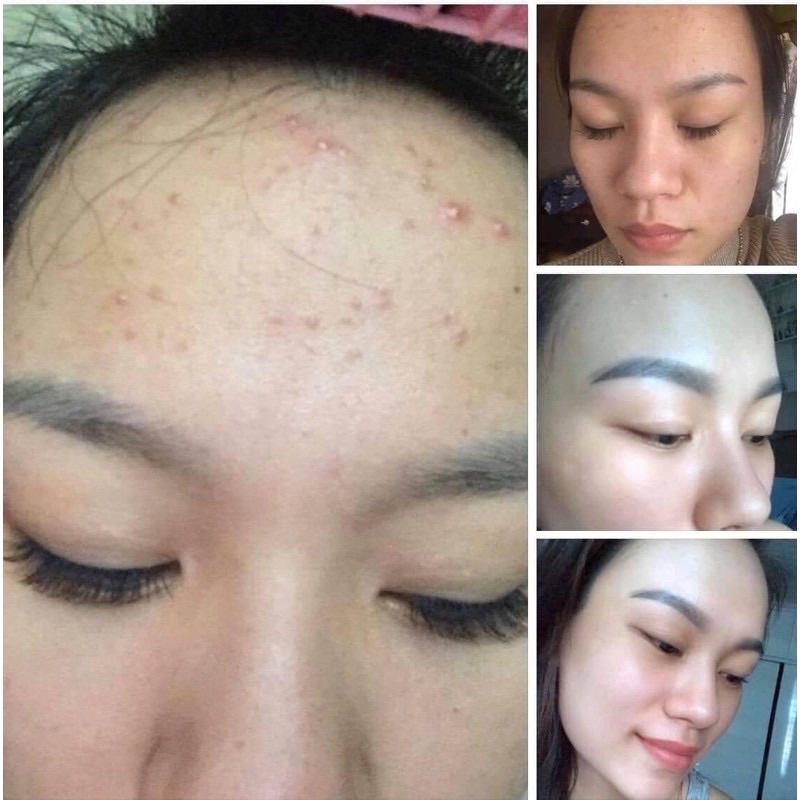 Serum Mộc Beauty Cho Da Mụn Thâm