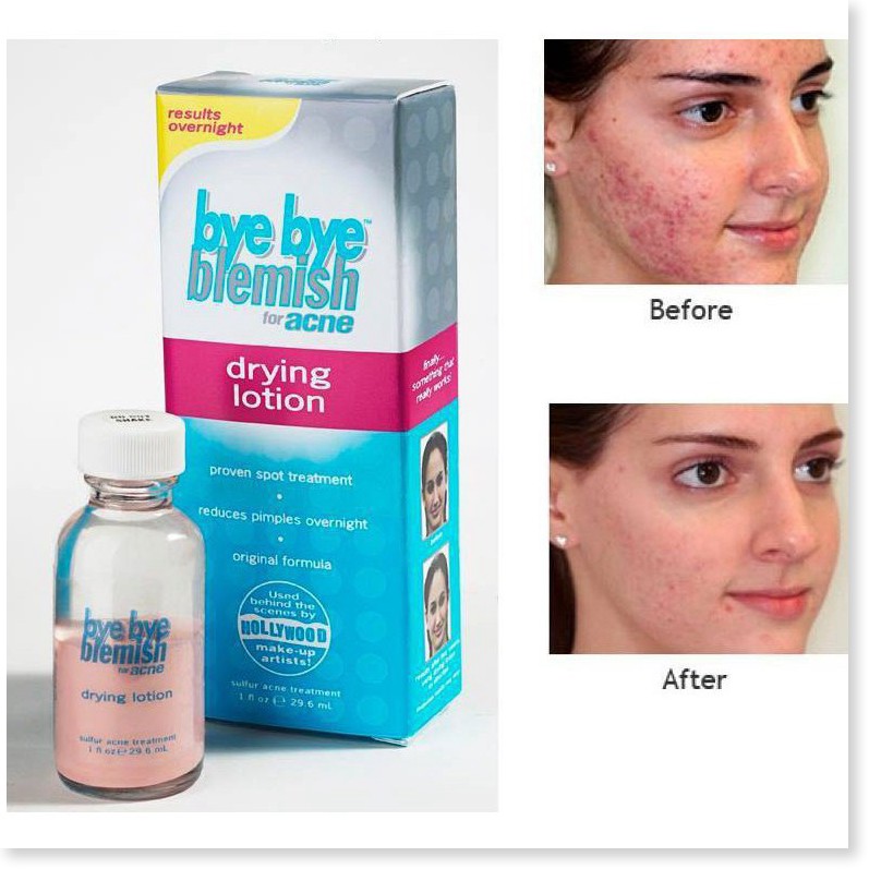 [Mã giảm giá mỹ phẩm chính hãng] Kem Dành Cho mụn Bye Bye Blemish For Acne Drying Lotion