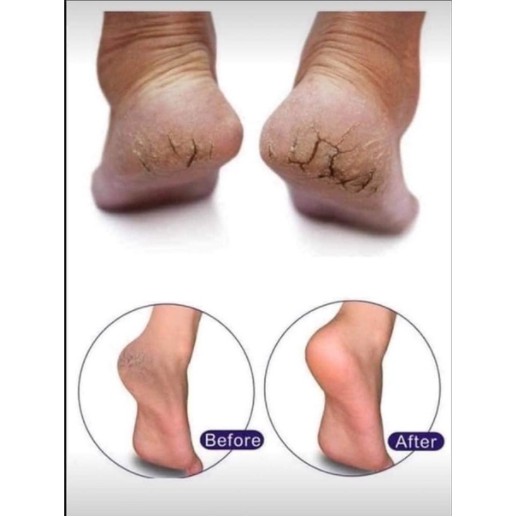 kem nứt gót chân Kpem Foot Cream giảm nẻ chân, nứt chân, khô da chân, dưỡng gót chân [Tặng máy massage mặt]