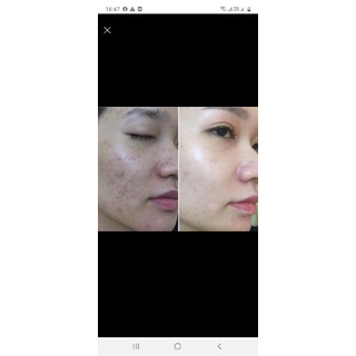 serum mụn (handmade)