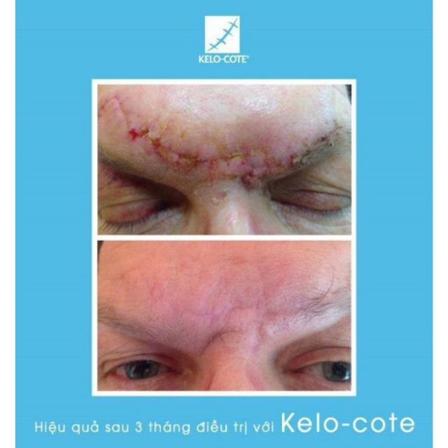 ( Nhập khẩu Mỹ) Gel trị Kelo-cote tuýp 6g và 15g