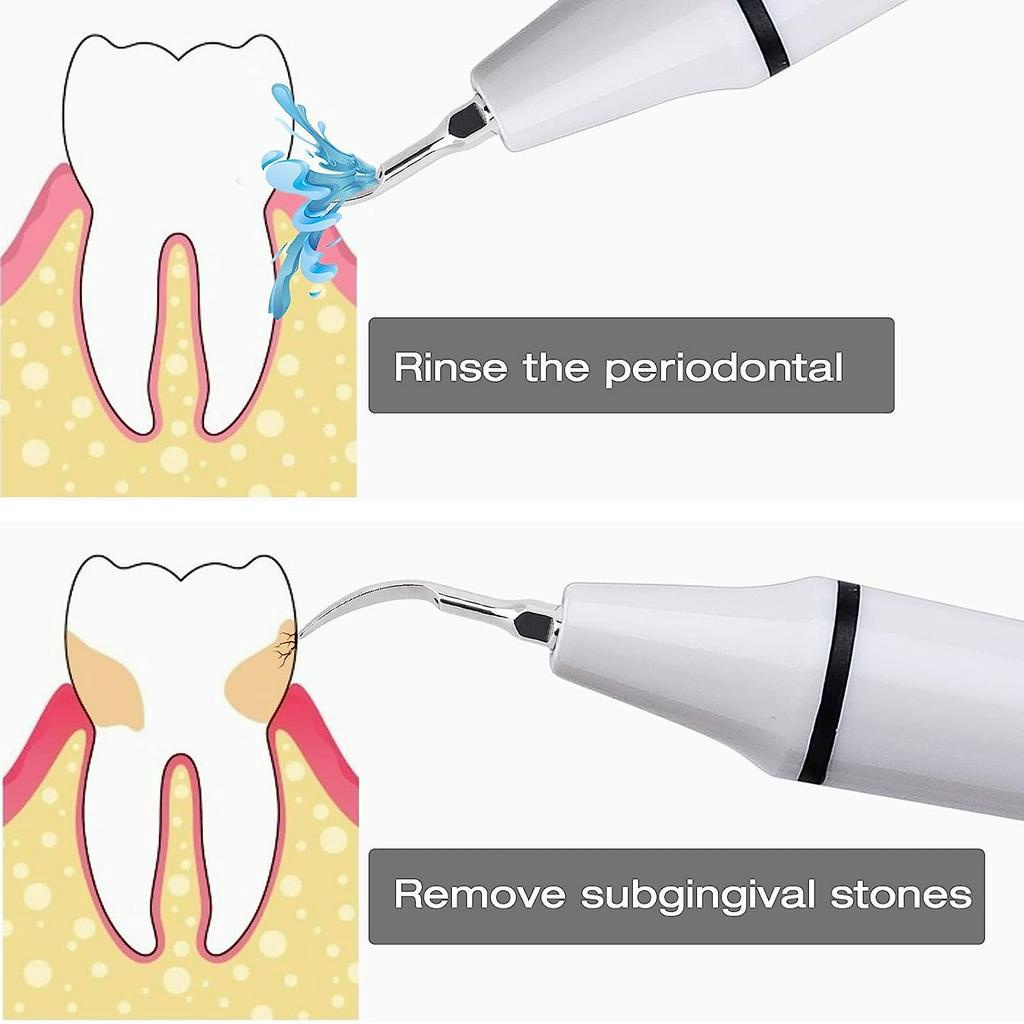 1 Đầu Cân Điện Siêu Âm Cho Nha Khoa