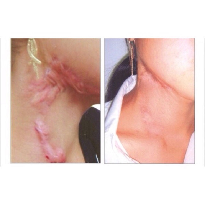 [CHÍNH HÃNG] Kem sẹo lồi Rejuvasil scar 10g | BigBuy360 - bigbuy360.vn