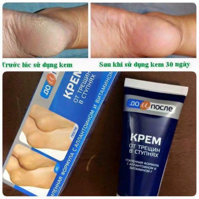 Kem trị nứt gót chân Nha Kpem