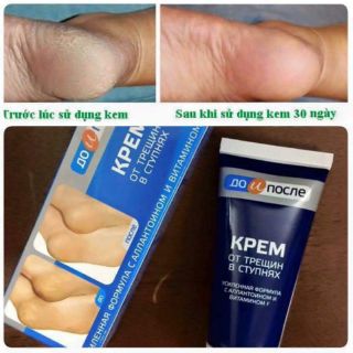 Kem trị nứt gót chân Nha Kpem