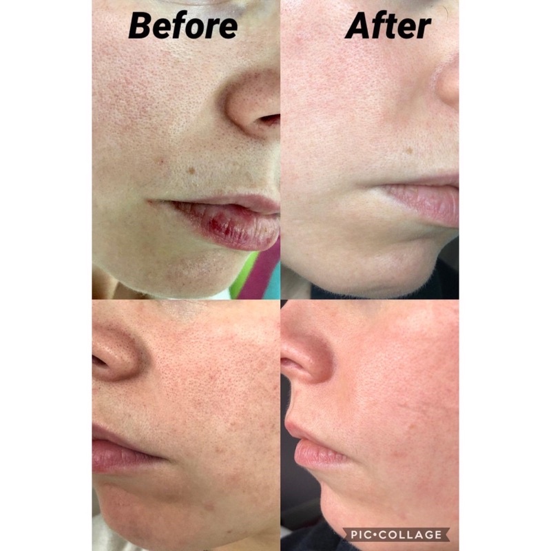 Tẩy da chết hóa học Alpha Hydrox AHA soufflé 12% Glycolic Aha | BigBuy360 - bigbuy360.vn