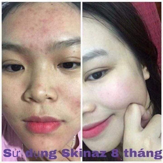 Combo skinaz ( kem AC + tinh chất AC)