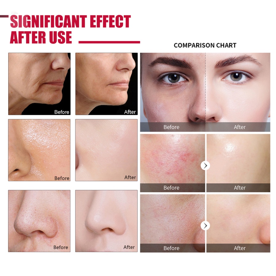 Tinh Chất Axit Hyaluronic 30% + BHA 2% Axit Salicylic Giúp Hỗ trợ giảm mụn Hiệu Quả