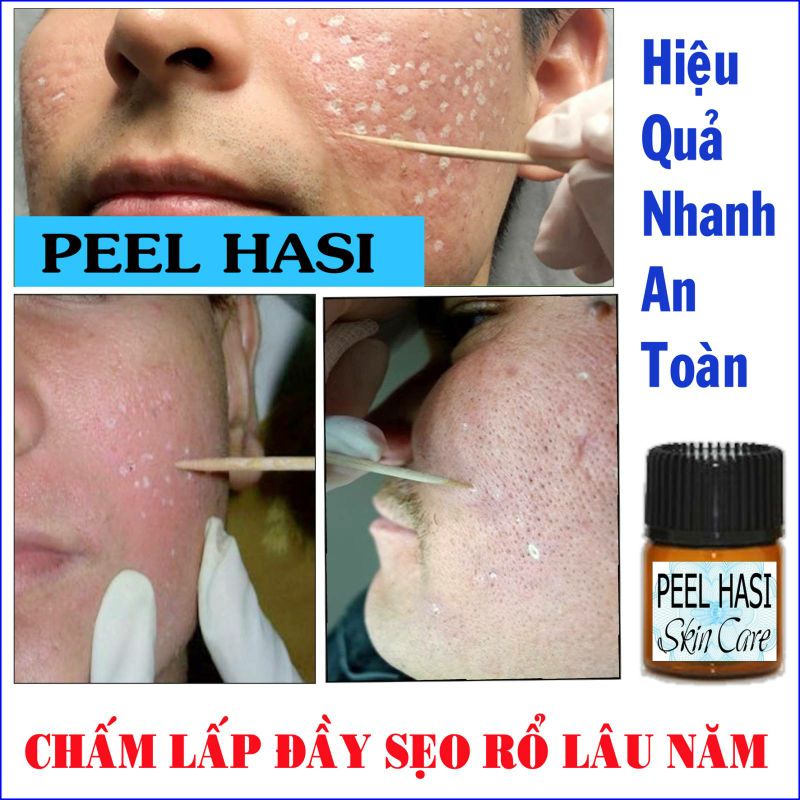 Chấm Đầy SẸO RỖ Lâu Năm. Quét Nám Tàn Nhang Peel HA SI