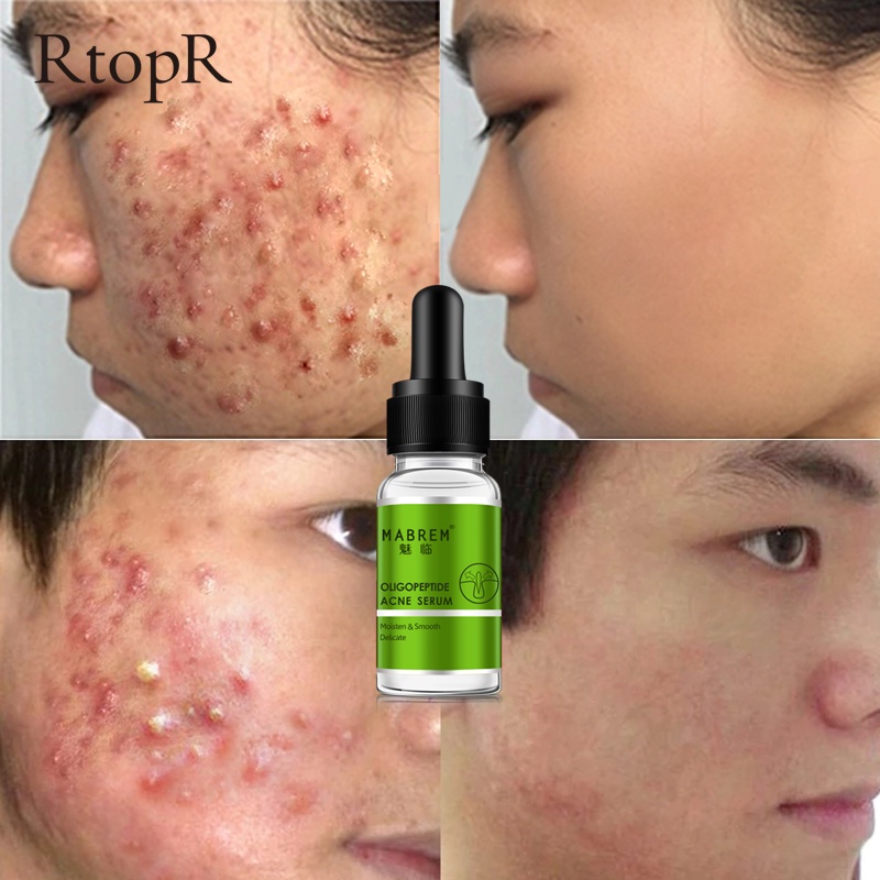 Serum MABREM Oligopeptide Hỗ Trợ Giảm Mụn Dưỡng Ẩm Làm Trắng Da Chống Nếp Nhăn Giúp Thu Nhỏ Lỗ Chân Lông Và Sáng Da sáng da kiềm dầu chống lão hóa da giúp da siêu căng bóng 10ml