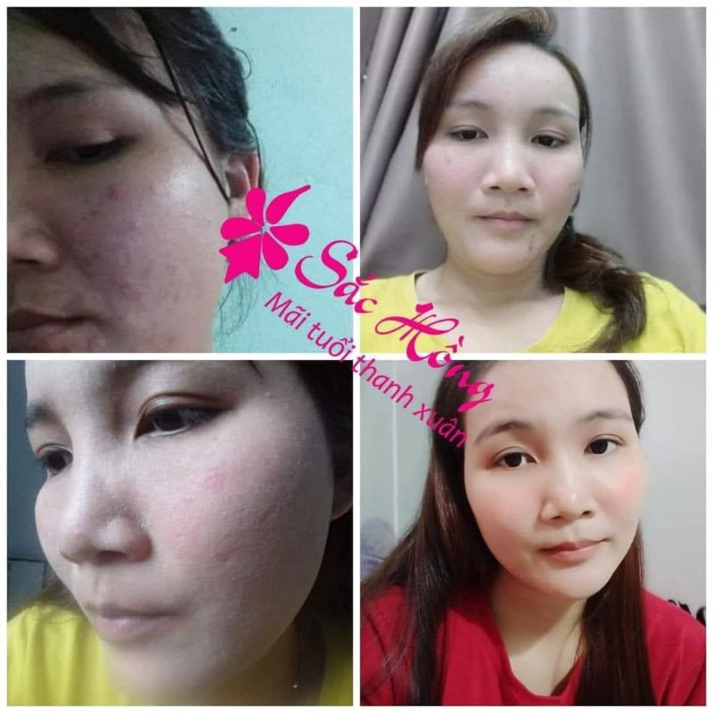 [FREESHIP + QUÀ TẶNG 🎁] Ngừa mụn - mờ nám Sắc Hồng - lọ 50ml | BigBuy360 - bigbuy360.vn