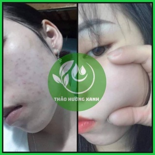 THẢO HƯƠNG XANH  SẠCH MỤN,HẾT THÂM