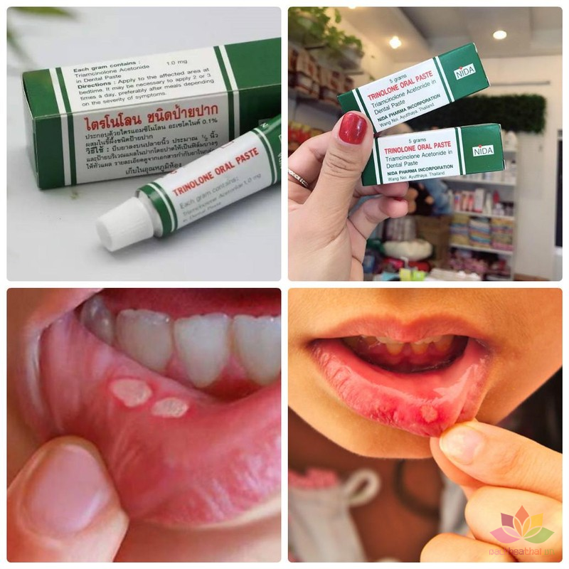 Kem ṫrị nhiệt miệng Trinolone Oral Paste Thái Lan