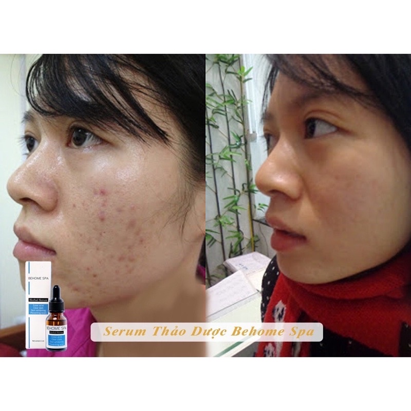 Serum mụn thảo dược Behome Spa 💕Freeship💕-  Mụn thâm, Mủ đều, mụn cám đánh bật sau 7 ngày | BigBuy360 - bigbuy360.vn