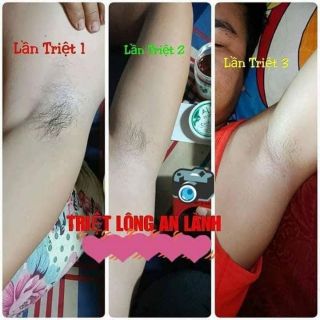 TRIỆT LÔNG NÁCH AN LÀNH