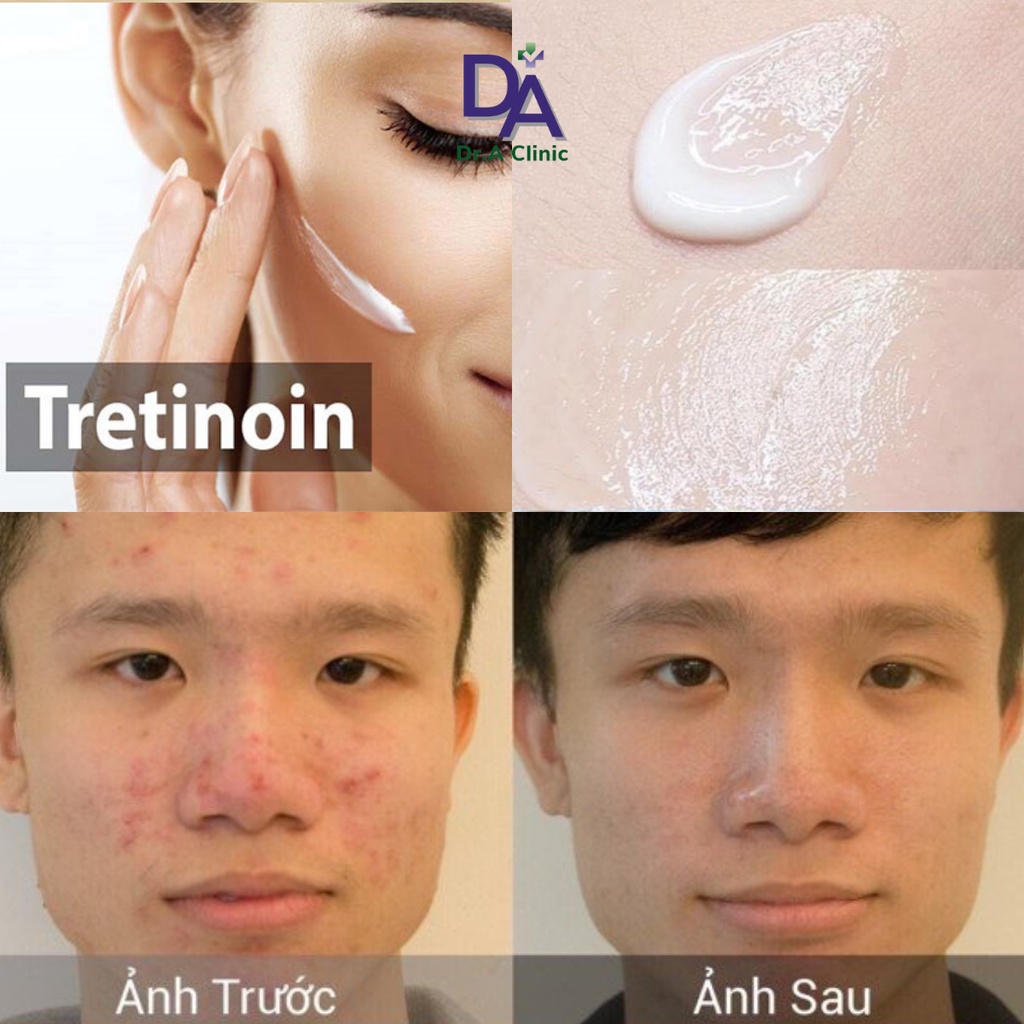 Retacnyl Tretinoin 0.05 Cream Galderma dạng kem cho da mụn ẩn mụn đầu đen và chống lão hóa - Dr.A Clinic