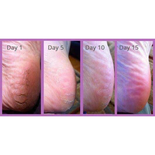 Kem Gỉam Nứt Gót Chân BANANA HEEL CREAM 30g Thái Lan