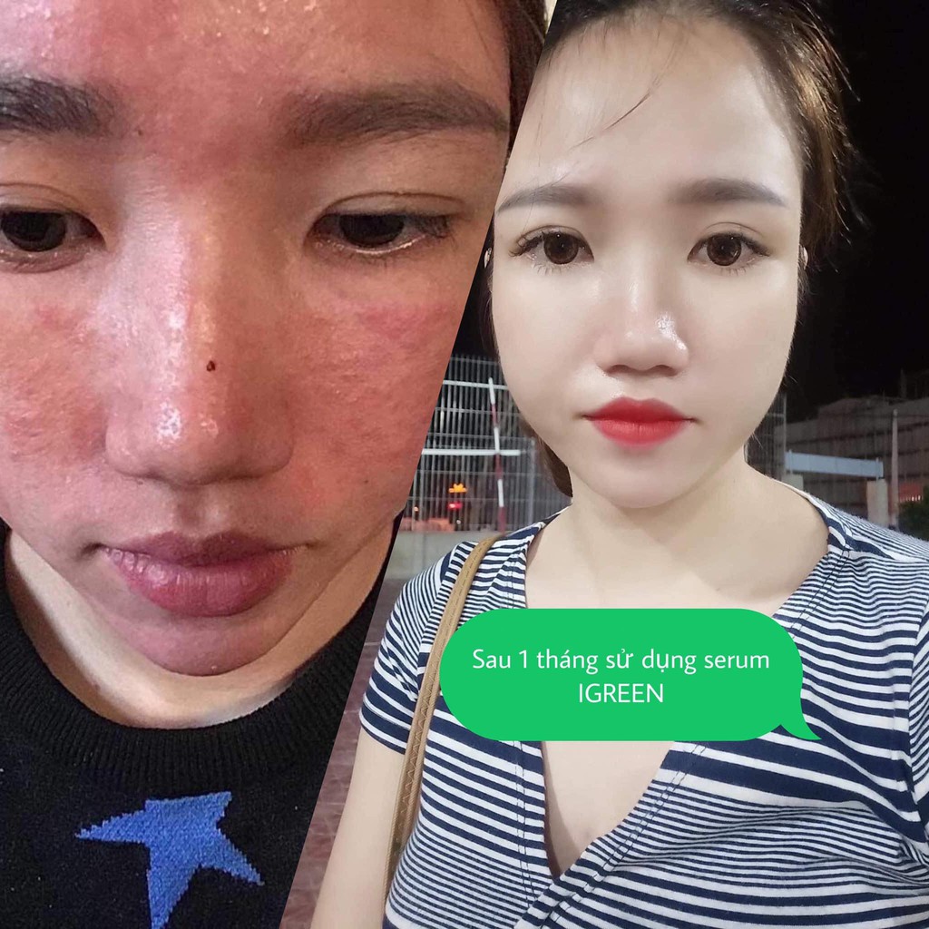 Serum Diếp Cá GIẢM MỤN, THÂM, SE KHÍT LỖ CHÂN LÔNG IGREEN - Acne Serum Diếp Cá IGREEN | BigBuy360 - bigbuy360.vn