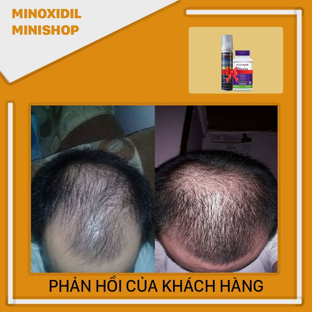 Minoxidil 5% Bọt (Foam) Mọc Râu Tóc kết hợp Biotin