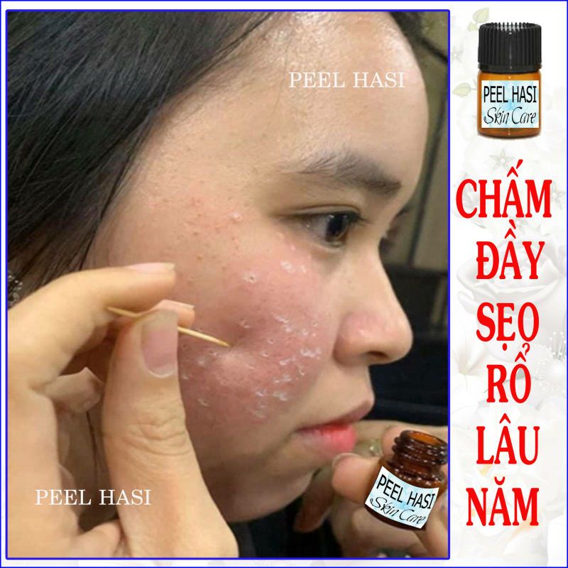 Chấm Đầy SẸO RỖ Lâu Năm. Quét Nám Tàn Nhang Peel HA SI