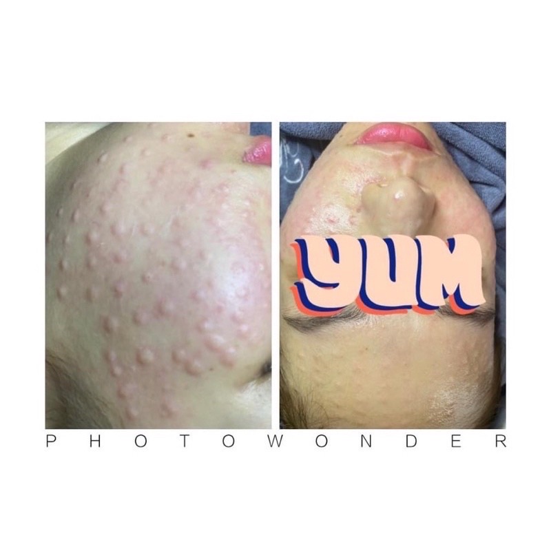 HA MESOTHERAPY  CĂNG BÓNG - TRẮNG DA - LÀM ĐẦY LỖ CHÂN LÔNG