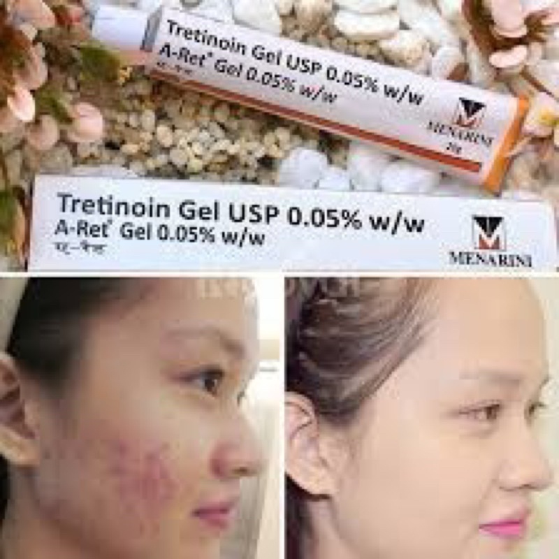 Kem Tretinoin Aret Ấn độ ,gel hỗ trợ giảm mụn