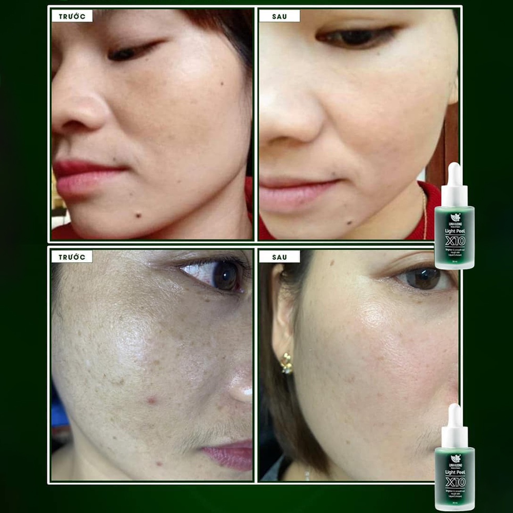 Peel da, thay da sinh học Linh Hương Light Peel X10 làm trắng da, tái tạo làn da mới, thay da tại nhà dung tích 30ml