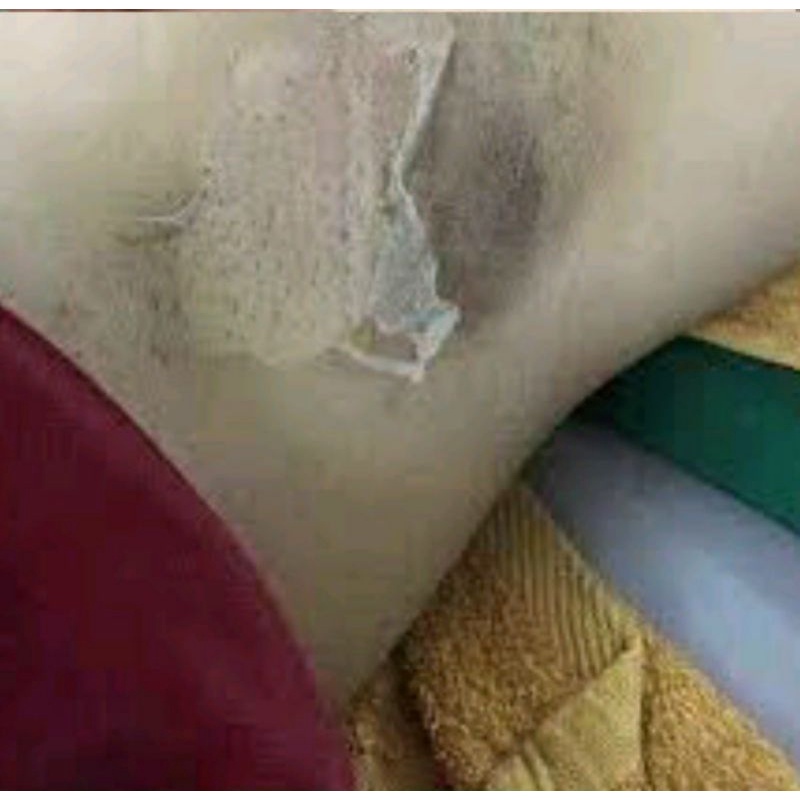 PELL LỘT TRẮNG _DA NÁCH .HẾT THÂM TẬN GỐC