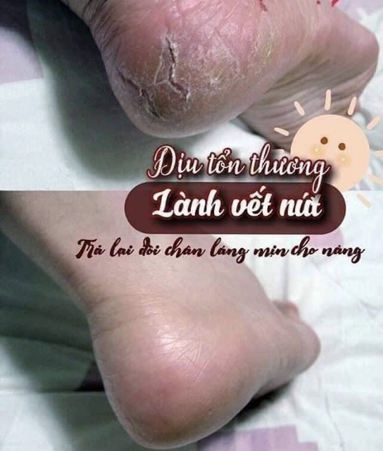 Tinh chất nứt gót chân(10mL) hết trong vòng 20 ngày