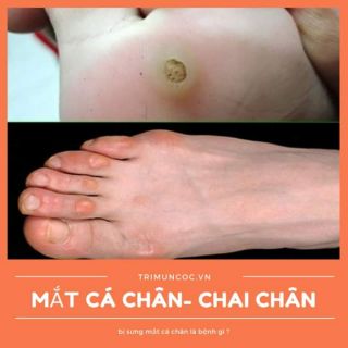 Miếng dán mụn cóc,  dánh cơm