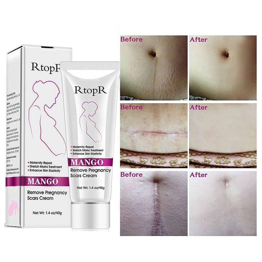 [Hàng mới về] Tuýp kem xoài tự nhiên trị rạn da hiệu Rtopr không gây kích ứng