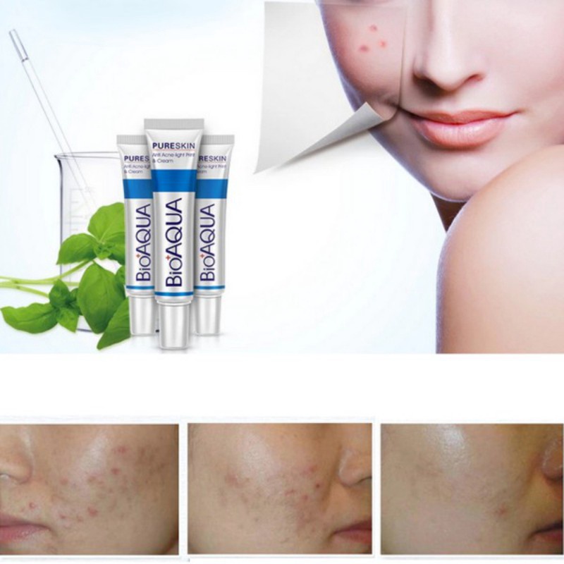 [Hàng mới về] Kem hỗ trợ giảm mụn Bioaqua cải thiện mụn trứng cá kiềm dầu sáng da 30g