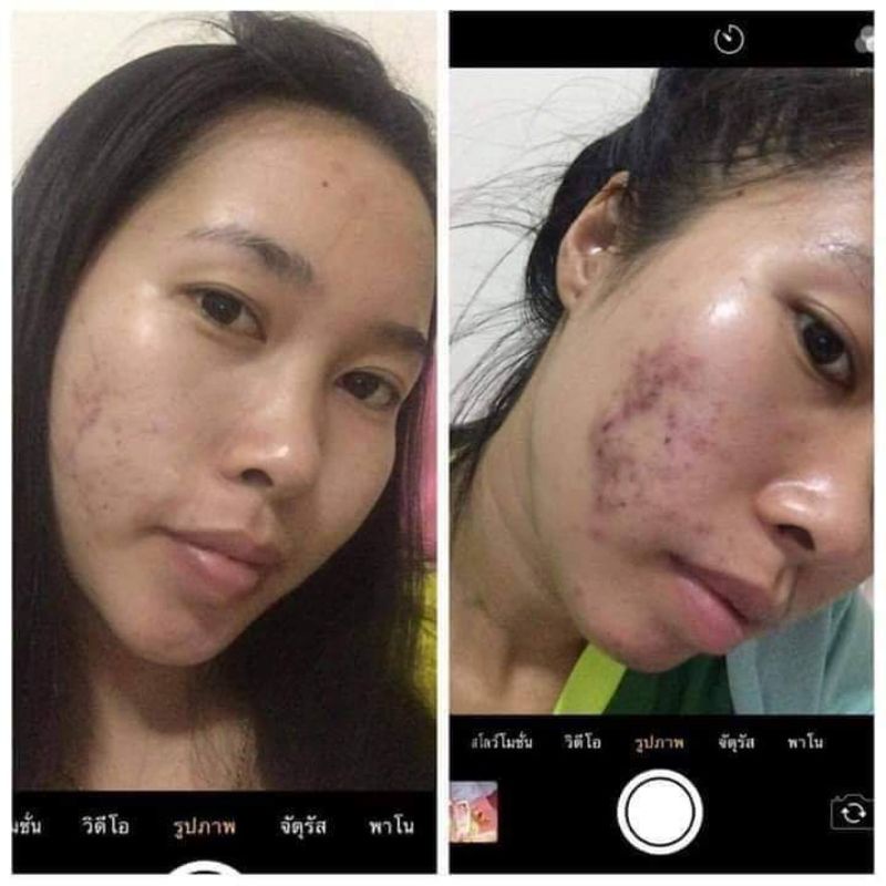 KEM OHO cream ☺ giảm mụn, thâm, sẹo 15g.