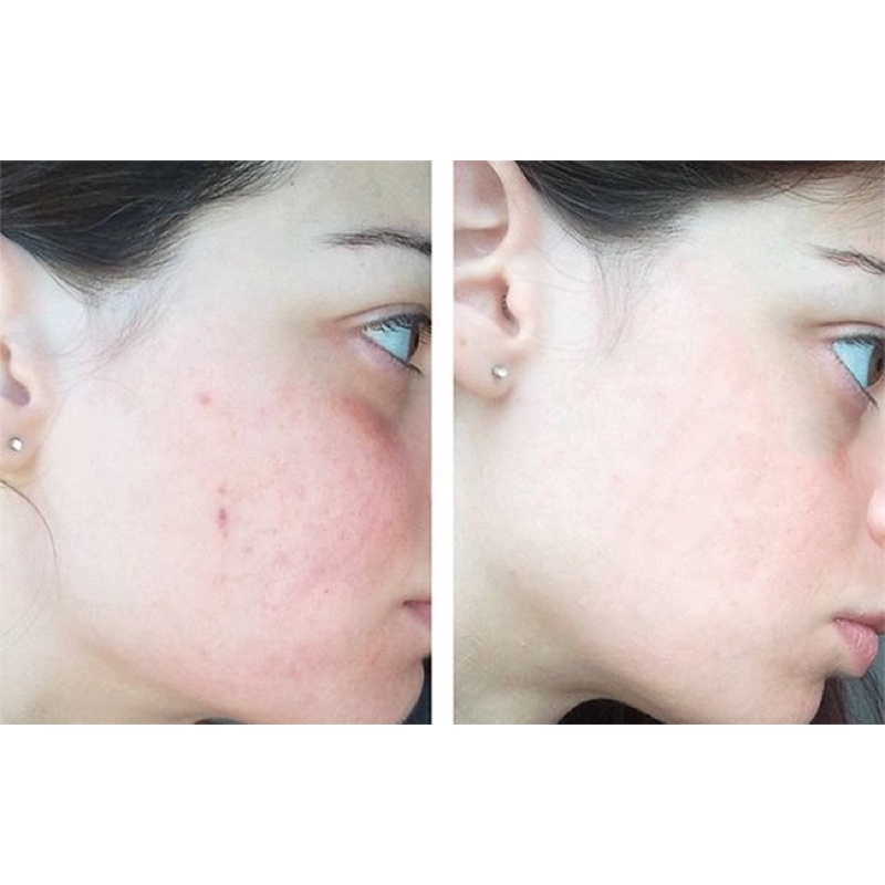 Tinh Chất Ngừa Mụn, Giảm Thâm The Ordinary Niacinamide 10% + Zinc 1%