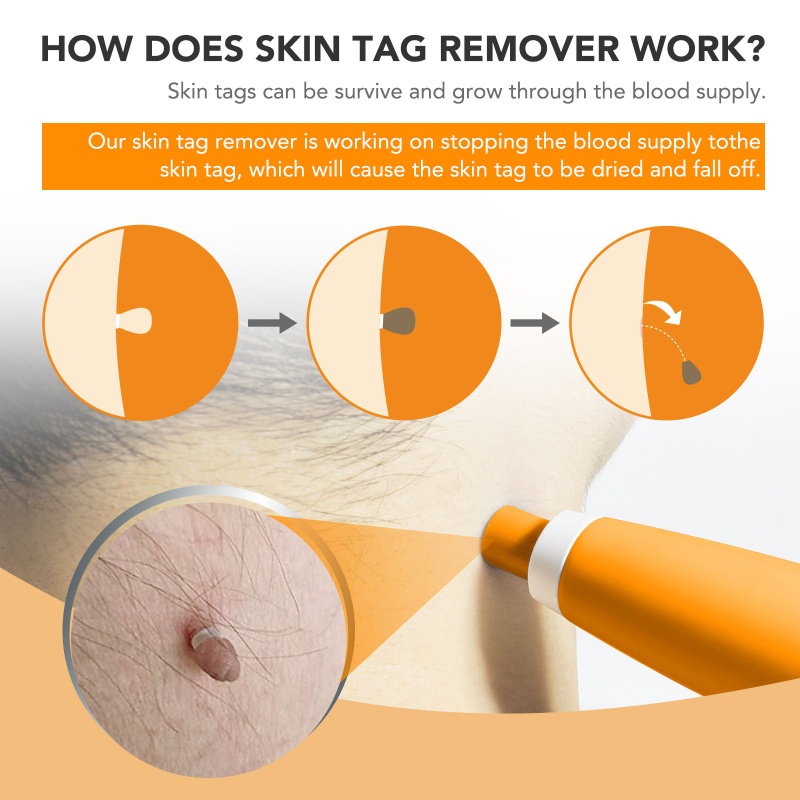 Dụng Cụ Tháo Nhãn Da Nhanh Chóng Không Đau 2-8 5Mm