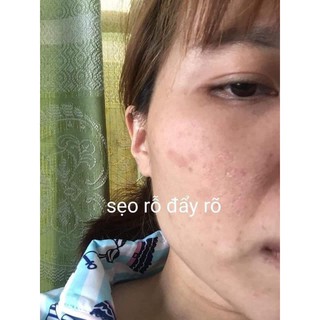 THAY DA MẶT TCA USA