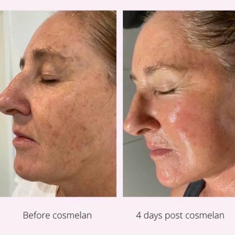 Kem giảm nám cao cấp Mesoestetic cosmelan 2